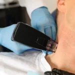 How Many Morpheus8 Sessions Do You Need